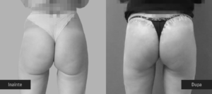 Inainte - După / Foto Operatie de Lifting, ridicare de fese, foto inainte / dupa