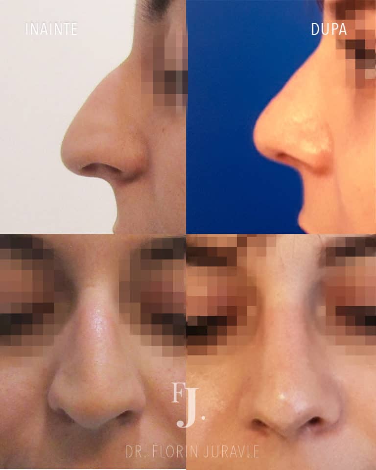 Operatie de rinoplastie, corectie nas coroiat la femeie, inainte si dupa