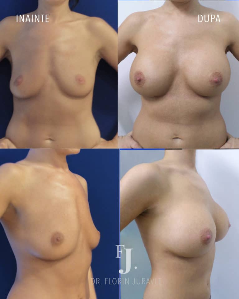Inainte - După / Foto inainte dupa implant mamar sani cu aspect natural, dr juravle