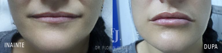 Inainte - După / Foto volum buze cu acid hialuronic poze inainte dupa