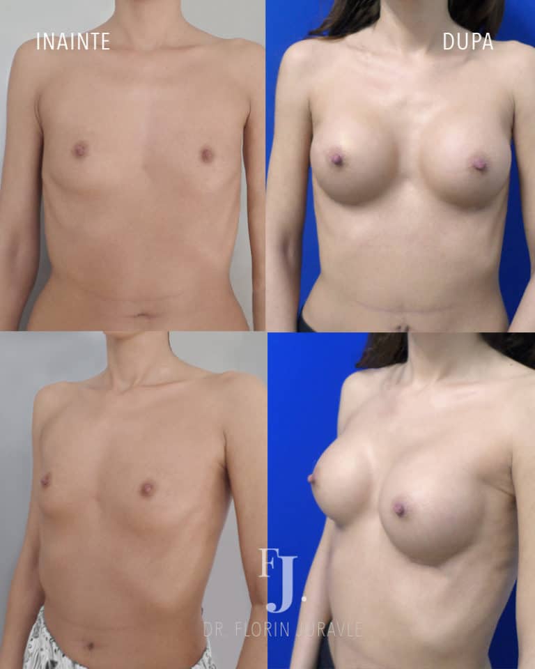 Inainte - După / Foto poze inainte dupa implant mamar dr juravle