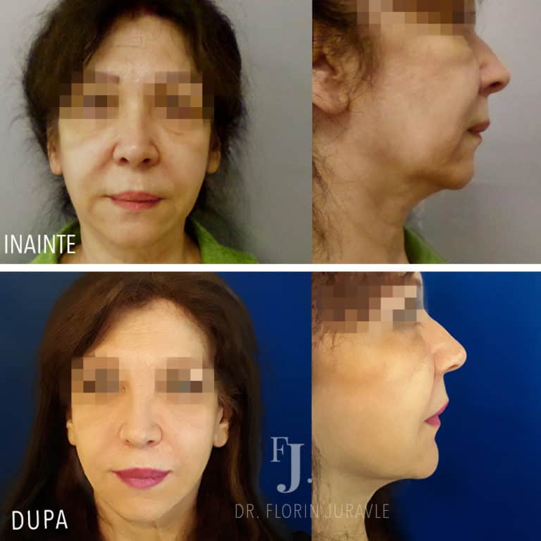 Inainte - După / Foto lifting facial, poze inainte si dupa, operatie dr Juravle, Bucuresti
