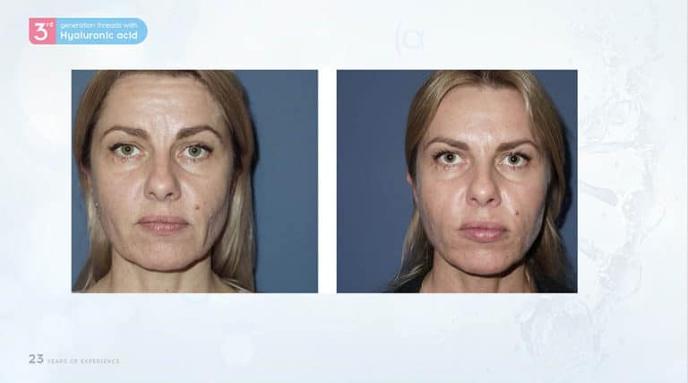 Inainte & Dupa / Fire Aptos cu Acid Hialuronic