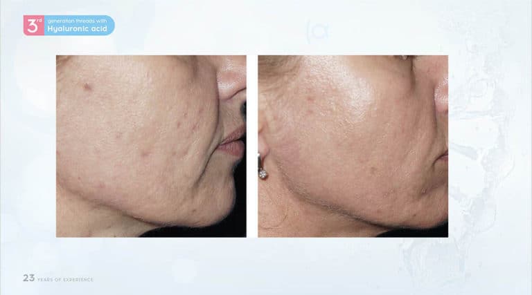 Inainte & Dupa / Fire Aptos cu Acid Hialuronic