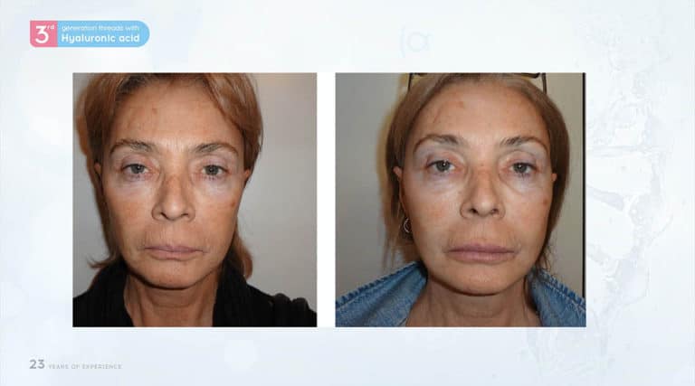 Inainte & Dupa / Fire Aptos cu Acid Hialuronic
