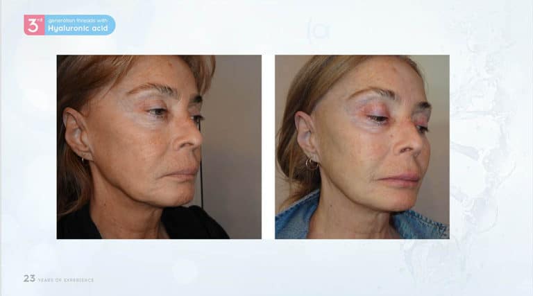Inainte & Dupa / Fire Aptos cu Acid Hialuronic