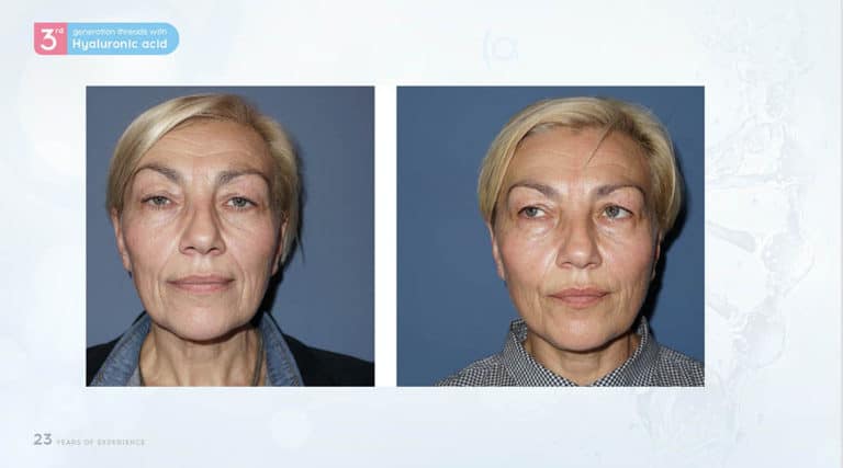 Inainte & Dupa / Fire Aptos cu Acid Hialuronic