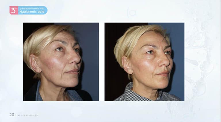 Inainte & Dupa / Fire Aptos cu Acid Hialuronic
