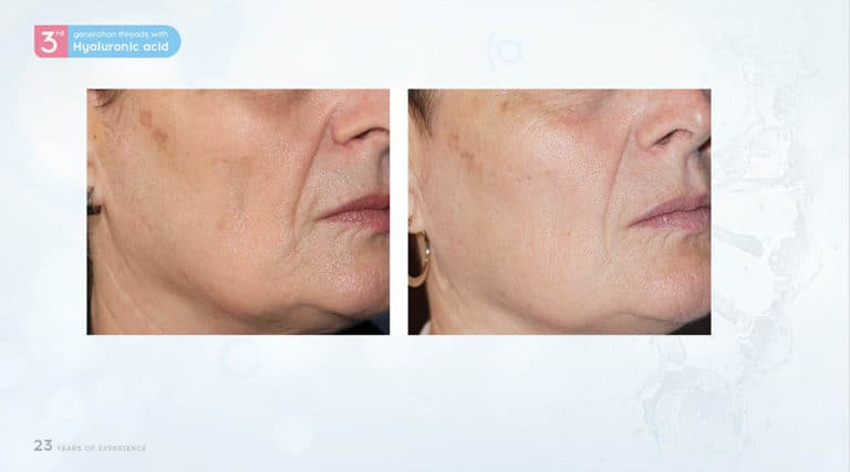 Inainte & Dupa / Fire Aptos cu Acid Hialuronic
