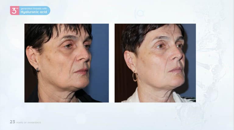 Inainte & Dupa / Fire Aptos cu Acid Hialuronic