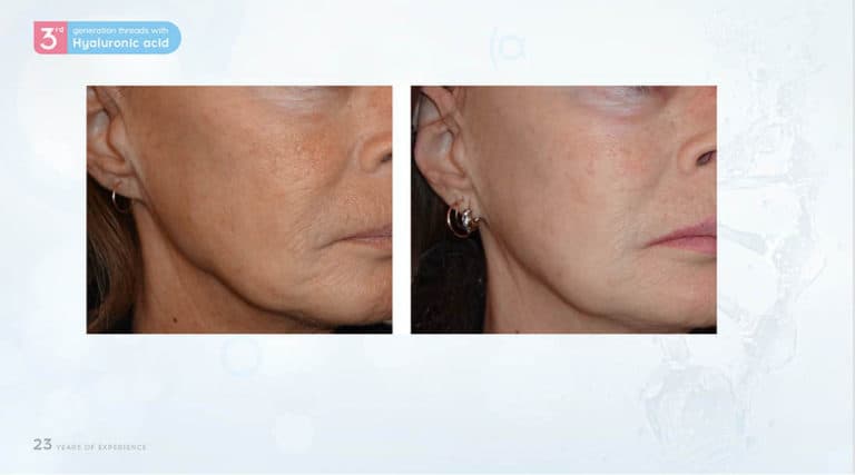 Inainte & Dupa / Fire Aptos cu Acid Hialuronic