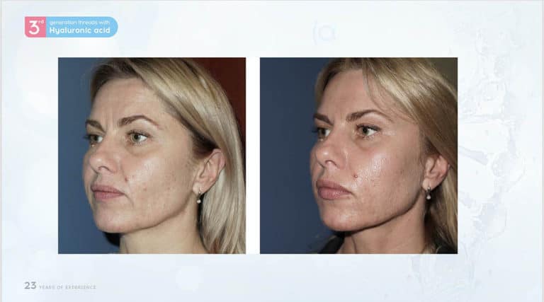 Inainte & Dupa / Fire Aptos cu Acid Hialuronic