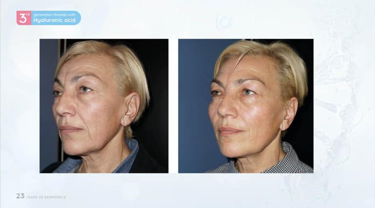 Inainte & Dupa / Fire Aptos cu Acid Hialuronic