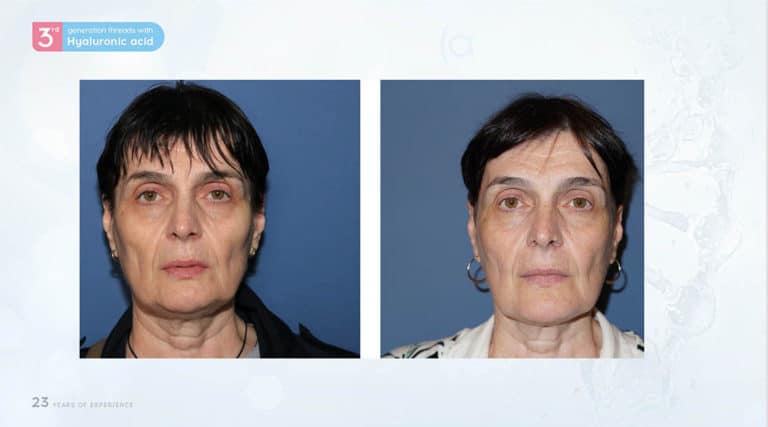 Inainte & Dupa / Fire Aptos cu Acid Hialuronic