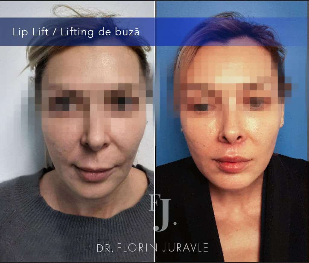 Lifting buza - Lip lift, noua procedura pentru | Dr. Florin Juravle - Chirurg Estetician
