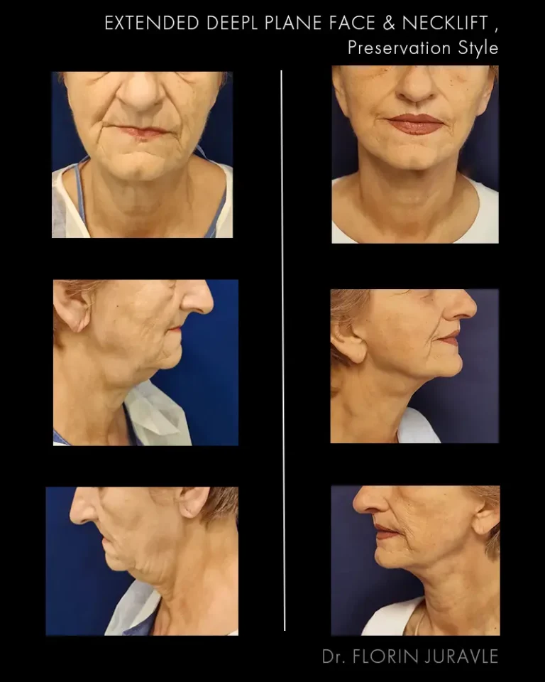 Inainte - După / Foto Lifting Facial Extended Deep-Plane, Preservation Style , Dr. Florin Juravle, poze inainte si dupa operatie