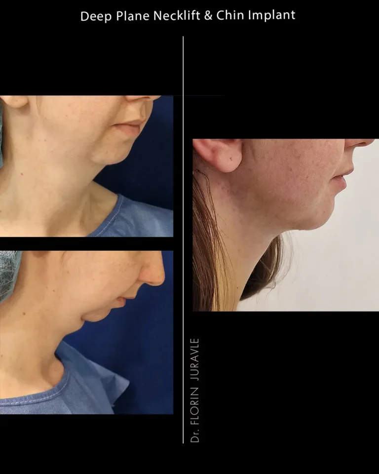 Inainte - După / Foto lifitng de gat Deep plane si implant de barbie poze inante is dupa operatie estetica realizata de dr. Florin Juravle