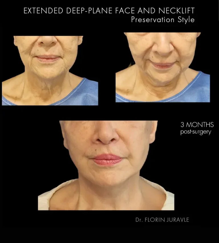 Inainte - După / Foto Lifting facial deep plane facut de Dr Juravle, cum arata inainte si la 3 luni de la operatie