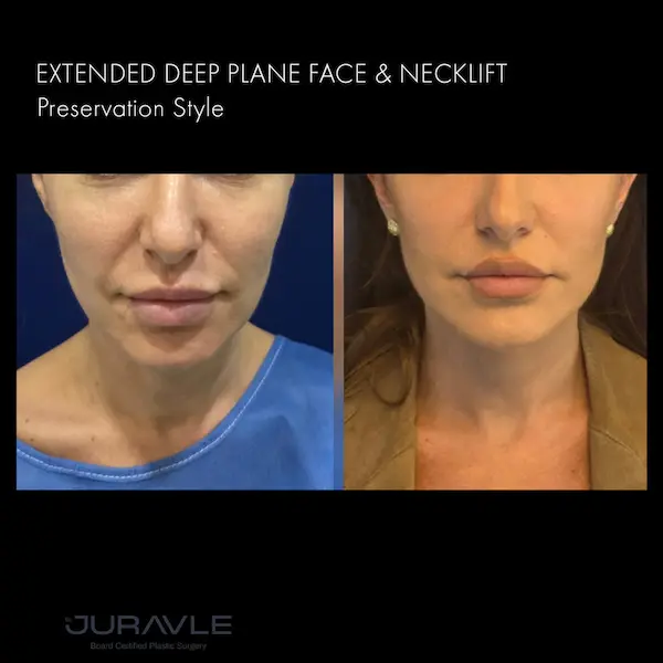Inainte - După / Foto facelift caz 17 dr Juravle bucuresti Romania
