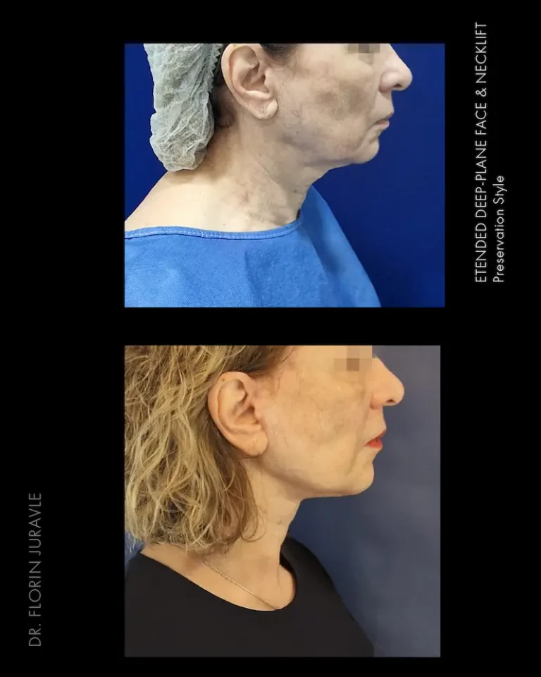 Inainte - După / Foto rezultat lifting facial chirurgical realizat de dr Flrin Juravle , Romania femeie aprox 55 ani , din profil