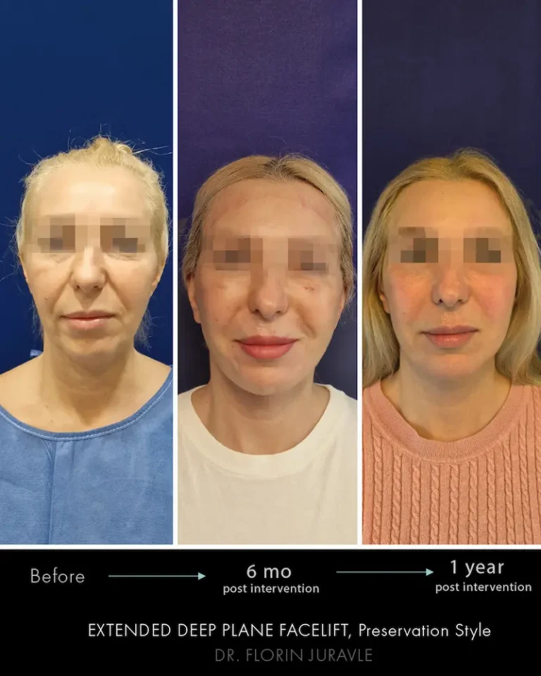 Inainte - După / Foto cum arata fata dupa lifting facial la 3 luni, 6 luni, 1 an, deep plane dr Juravle