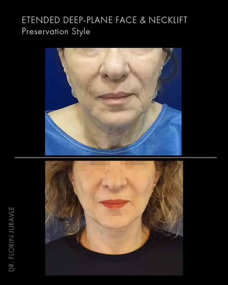 Inainte - După / Foto rezultat lifting facial chirurgical realizat de dr Flrin Juravle , femeie aprox 55 ani